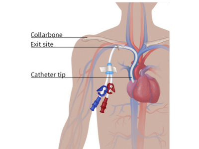 Vascular access (dialysis patients)